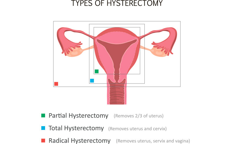 Hysterectomy